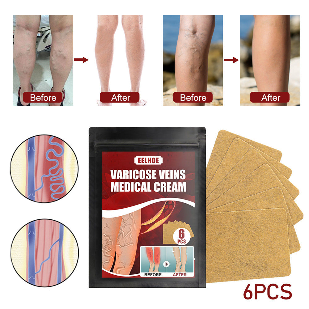 Leg Swelling, Earthworm Leg Vein Massage Pain Relief