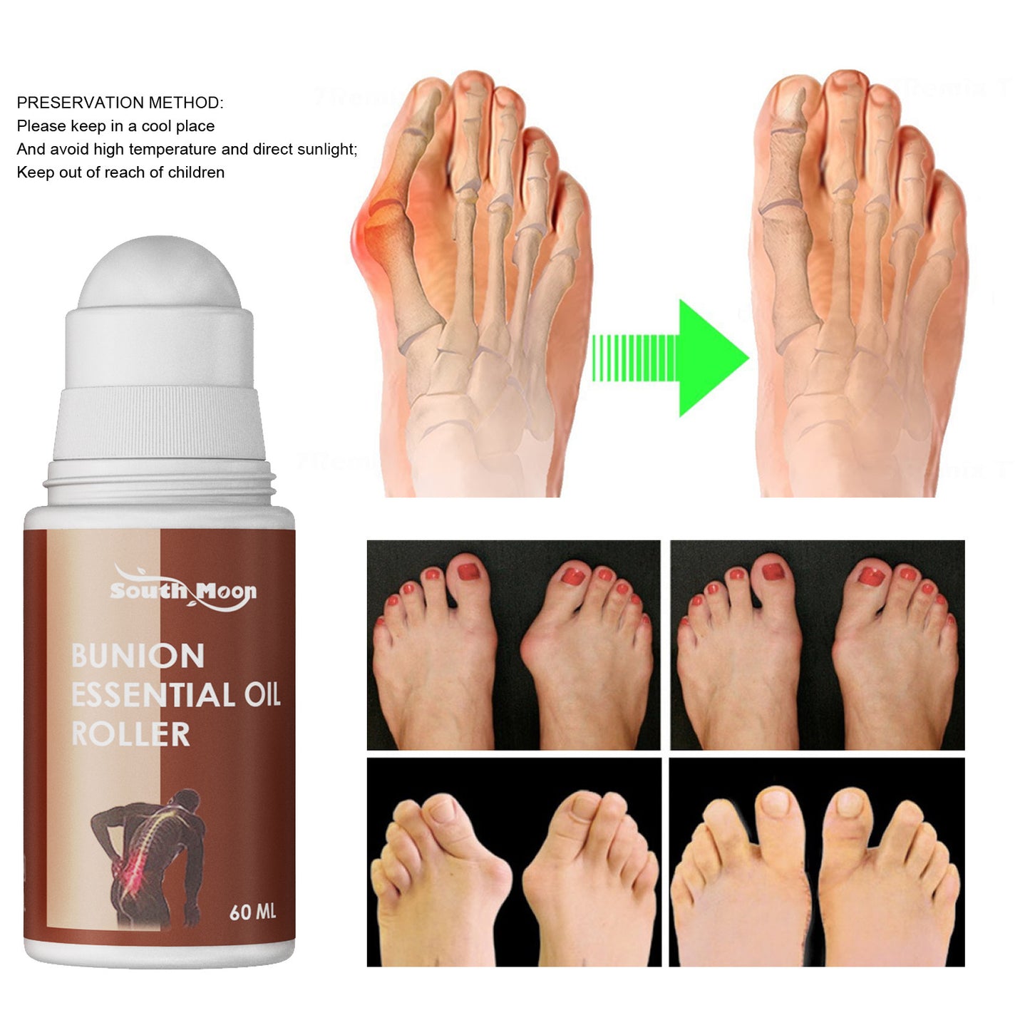 Correction Of Thumb Valgus With Thumb Bursitis Essential Oil Roller To Relieve Pain