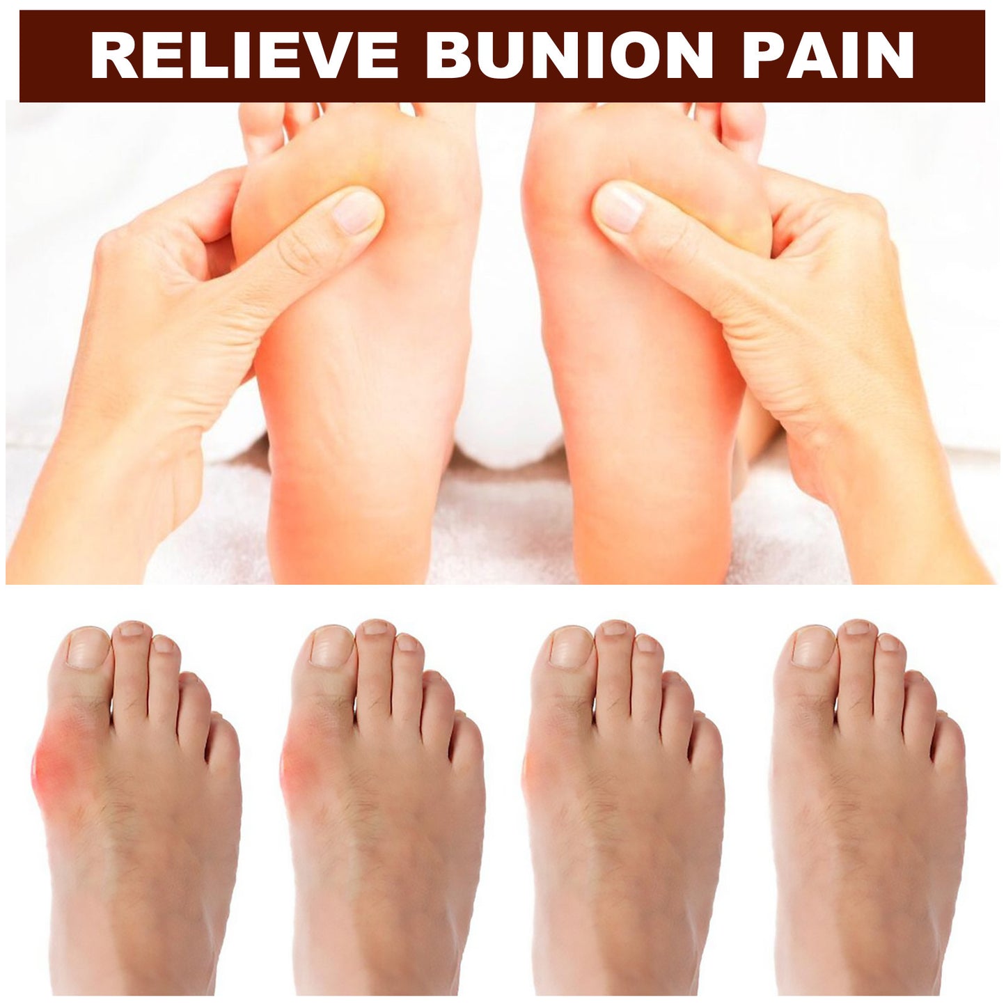 Correction Of Thumb Valgus With Thumb Bursitis Essential Oil Roller To Relieve Pain